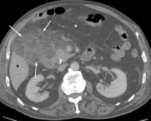 Figure 27.15 Aspect caractéristique d'une infiltration inflammatoire de la graisse des mésos (flèches) réalisant une augmentation de densité du tissu graisseux sous la forme d'un voile de densité intermédiaire entre la graisse pure (astérisque blanc) et la densité hydrique (astérisque noir). La topographie de cette infiltration inflammatoire renseigne sur l'organe touché. Il s'agit ici d'une infiltration située à la face inférieure du foie dans l'hypochondre droit consécutive à une cholécystite aiguë non visible sur cette coupe.