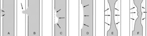 Figure 27.16 Images d'addition (A, B) et de soustraction (C-F) en TOGD. Les images d'addition sont définies par un débord du produit de contraste au-delà du liseré muqueux supposé (flèches). Ce débord peut être limité à l'épaisseur de la paroi et correspond plutôt à une ulcération (A). Il peut également être plus régulier et faire une hernie au-delà de la paroi qui correspond à un diverticule (B). Les images de soustraction sont définies par une absence d'opacification au contact du liseré muqueux supposé (flèches). Lorsque le refoulement a des bords irréguliers (C), cela témoigne plutôt du développement sur la paroi d'une tumeur maligne. Le refoulement régulier du produit de contraste par rapport à la ligne théorique du liseré muqueux avec des angles obtus évoque un processus bénin (D). Les sténoses sont des rétrécissements de la lumière du tube digestif. Ces rétrécissements peuvent être centrés, longs et réguliers (E) (flèches). Dans ce cas, cela évoque une atteinte bénigne. Les sténoses peuvent être plus courtes, irrégulières et excentrées (F) (flèches) ; l'aspect est évocateur d'une tumeur maligne.