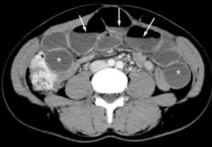 Figure 27.17 Niveaux hydroaériques en TDM sur une coupe axiale après injection de produit de contraste. Les niveaux hydroaériques sont reconnaissables sous la forme d'une ligne parfaitement horizontale (flèches) limitant en haut des clartés aériques, et en bas des densités hydriques. On observe par ailleurs que les anses grêles sont dilatées et pleines de liquide (astérisques) ; l'ensemble signe une stagnation du liquide et de l'air dans l'intestin, et donc une occlusion.