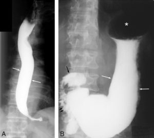 Figure 27.2 Exemple de TOGD. La lumière de l'œsophage (A) et de l'estomac (B) est opacifiée par un produit de contraste liquide à base de sulfate de baryum ingéré par le patient. Le produit de contraste vient mouler les parois de l'œsophage et de l'estomac, qui correspondent à l'interface avec la muqueuse appelée le liseré muqueux (flèches blanches). Le TOGD permet également d'objectiver l'anatomie (forme, taille et position) de l'œsophage, de l'estomac, du bulbe (flèche noire), et du cadre duodénal (double flèche noire). Plusieurs clichés peuvent être réalisés en faisant tourner le patient pour dégager toutes les portions et toutes les faces de l'œsophage, de l'estomac et du cadre duodénal. Astérisque : fundus gastrique.