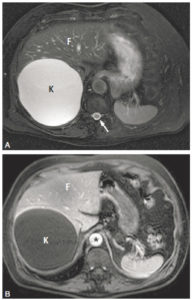 Figure 27.22 Exemple d'IRM en pondération T2 (A) et T1 (B) du foie (F). La séquence en pondération T2 est reconnue car le LCS est en hypersignal (flèche). À la face postérieure du foie, on observe une volumineuse formation en franc hypersignal T2 et en franc hyposignal T1 (K). La séquence en pondération T1 a été effectuée après injection de produit de contraste, comme en témoigne le rehaussement de la lumière de l'aorte (astérisque). Cela a permis de confirmer que cette formation n'était le siège d'aucune prise de contraste. Cette formation est donc une formation liquidienne pure qui correspond à un kyste bénin.