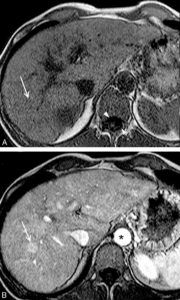 Figure 27.25 Exemple d'IRM en pondération T1 du foie avant (A) et après (B) injection intraveineuse de chélates de gadolinium. La séquence T1 est reconnue car le LCS est noir (têtes de flèche). L'injection de gadolinium est reconnue car la lumière de l'aorte devient blanche (astérisque). Au sein du parenchyme hépatique, on identifie après injection un nodule (B, flèche) qui est plus rehaussé que le foie adjacent. Ce nodule était invisible avant injection. Il existe donc une petite tumeur hépatique plus vascularisée que le foie adjacent.