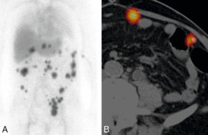 Figure 27.27 Image d'une scintigraphie splénique chez un patient présentant de multiples formations tissulaires abdominales apparues dans les suites d'une splénectomie. Image d'une scintigraphie splénique en projection abdominale (A) : multiples lésions tissulaires intra-abdominales responsables d'une séquestration des hématies fragilisées radiomarquées, confirmant leur nature splénique (splénose abdominale). Image scintigraphique en coupe axiale fusionnée à une TDM (B).