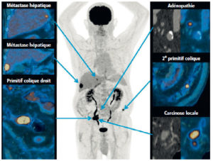 Figure 27.28 Évaluation métabolique en TEP au 18F-FDG d'un cancer du côlon droit. L'étude métabolique permet d'évaluer l'extension de la maladie.