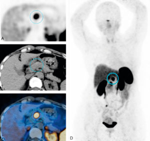 Figure 27.29 Évaluation moléculaire en TEP aux analogues de la somatostatine radiomarqués au 68Ga d'une lésion pancréatique. L'intense fixation des analogues de la somatostatine témoigne d'une surexpression des récepteurs à la somatostatine par la lésion, caractéristique d'une tumeur neuroendocrine.