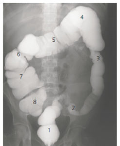 Figure 27.4 Exemple de lavement opaque. La lumière de l'ensemble du cadre colique est opacifiée grâce à l'introduction par une canule rectale d'un produit de contraste liquide à base de sulfate de baryum. Les clichés réalisés donnent des informations sur l'anatomie du cadre colique, son calibre et la régularité du liseré muqueux de chacune de ses portions. 1. Rectum ; 2. côlon sigmoïde ; 3. côlon descendant (gauche) ; 4. angle colique gauche ; 5. côlon transverse ; 6. angle colique droit ; 7. côlon ascendant (droit) ; 8. cæcum.