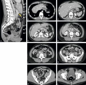 Figure 27.5 Reconstruction sagittale médiane (A) et coupes horizontales (B-I) de la région abdominopelvienne en TDM après injection intraveineuse de produit de contraste. La région abdominale est divisée en deux par le plan du mésocôlon transverse (trait jaune), tendu entre le pancréas et le côlon transverse. L'étage sus-mésocolique comprend toutes les glandes annexes du tube digestif et la rate ; l'étage sous-mésocolique contient principalement l'intestin grêle et le côlon. Les lobes inférieurs des poumons sont visibles et sont de densité aérique (astérisque). La cavité péritonéale est normalement virtuelle ; les différents replis du péritoine, correspondant aux lames porte-vaisseaux des organes (mésentère, mésocôlon, omentum), sont de densité graisseuse. Le rachis est de densité osseuse. 1. Aorte ; 2. veine porte ; 3. pancréas ; 4. foie ; 5. côlon transverse ; 6. veines hépatiques ; 7. branche gauche de la veine porte ; 8. rate ; 9. estomac ; 10. veine cave inférieure ; 11. reins ; 12. vésicule biliaire ; 13. duodénum ; 14. muscles grands psoas ; 15. côlon ascendant ; 16. côlon descendant ; 17. côlon sigmoïde ; 18. rectum ; 19. intestin grêle ; 20. récessus rectovésical (Douglas) ; 21. mésocôlon transverse ; 22. mésentère ; 23. mésosigmoïde ; 24. grand omentum (épiploon).