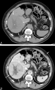 Figure 27.6 Exemple d'examen tomodensitométrique réalisé avant (A) et après (B) injection de produit de contraste iodé par voie intraveineuse. Avant injection de produit de contraste, la lésion qui occupe la majeure partie du foie (flèches) présente une densité très proche de celle du parenchyme hépatique adjacent. Seule sa portion centrale apparaît de densité moins élevée (astérisque). Après injection de produit de contraste, les lumières vasculaires telles que l'aorte (2) se rehaussent fortement. Les organes richement vascularisés tels que le foie (1) ou la rate (4) se rehaussent également de façon plus marquée que les structures très peu vascularisées comme le muscle (3) ou les tissus graisseux (flèches courtes). La tumeur (flèches) est moins vascularisée que le foie. Elle est donc mieux visible après injection car elle se rehausse moins que le parenchyme adjacent. Sa portion centrale (astérisque) n'est le siège d'aucun rehaussement visible. Elle est probablement dévascularisée, nécrotique au centre.