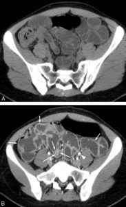 Figure 27.7 Exemple d'entéroscanner avant (A) et après (B) injection intraveineuse de produit de contraste iodé. L'instillation par une pompe dans une sonde nasojéjunale placée au-delà de l'angle dudodénojéjunal permet de remplir rapidement d'eau les anses grêles d'eau et de les déplisser. Après injection de produit de contraste, confirmée par l'observation d'un rehaussement net de la lumière des vaisseaux comme l'artère iliaque externe gauche par exemple (tête de flèche), la paroi des anses intestinales vascularisées se rehausse (flèches courtes) et permet de mettre en évidence une tumeur (flèches) développée dans la lumière d'une anse intestinale à partir de la paroi.