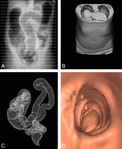 Figure 27.8 Les différentes étapes de réalisation d'un coloscanner. Dans un premier temps, le côlon est gonflé par une pompe au CO2 via une canule introduite dans le rectum, puis des coupes tomodensitométriques axiales fines jointives sont réalisées (A). Ces coupes sont empilées les unes sur les autres pour reconstruire l'abdomen et son contenu en 3D (B). De ce volume sont extraits les pixels situés à l'interface entre l'air de la lumière colique et la paroi et qui correspondent aux pixels situés sur le liseré muqueux (C). Il est possible de faire naviguer une caméra virtuelle au sein de la lumière de cette reconstruction de la muqueuse du côlon en appliquant une couleur artificielle à la paroi. L'image obtenue est très similaire à celle d'une endoscopie (D).