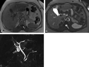 Figure 27.9 Exemple d'IRM centrée sur la partie haute de l'abdomen en pondération T1 (A), pondération T2 (B) et séquences de cholangio-IRM (C). En pondération T1 (A), les différents organes explorés (foie, pancréas, rate, etc.) présentent des niveaux de gris intermédiaires. On reconnaît la séquence en pondération T1 car le LCS est noir (flèche). La graisse apparaît en hypersignal relatif (astérisques). Sur la coupe en pondération T2 (B), le LCS (flèche) et le liquide contenu dans la vésicule biliaire (double flèche) sont blancs. Les différents organes qui composent la partie haute de l'abdomen ont des niveaux de gris intermédiaires, légèrement différents de ceux de la coupe en pondération T1. La graisse reste en hypersignal relatif (astérisques). La séquence de cholangio-IRM est une séquence hyperpondérée T2 (C) dans laquelle seuls les liquides stagnants sont blancs. Tout le reste est noir. Cette coupe coronale oblique passe par la voie biliaire principale (flèche), quelques voies biliaires intrahépatiques, le conduit pancréatique (de Wirsung, tête de flèche). On voit également une portion de la vésicule biliaire (double flèche). Cette séquence est très utile pour analyser les processus pathologiques qui peuvent toucher les voies biliaires (sténose, dilatation, calcul, tumeur, etc.).