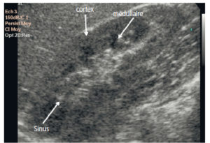 Figure 28.1 Échographie rénale : coupe longitudinale. Le cortex apparaît discrètement hypoéchogène (comparativement au parenchyme hépatique) homogène. La médullaire est plus hypoéchogène que le cortex. Il existe donc à l'état normal une différenciation corticomédullaire.