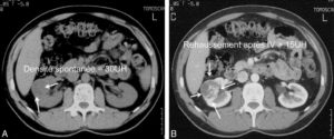 Figure 28.10 TDM rénale, sans injection (A), et après injection à la phase corticale (B). Masse solide du rein droit : lésion encapsulée, hétérogène, avec une double composante solide, tissulaire hypervascularisée, et nécrotique ou nécrotico-hémorragique (flèches). L'injection de produit de contraste montre un rehaussement de densité précoce et intense des zones charnues, alors que les plages de nécrose sont avasculaires.