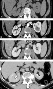 Figure 28.2 Examen tomodensitométrique des reins. Quatre phases d'étude des reins et de l'arbre urinaire. A. Sans injection. B, C. Néphrogramme corticomédullaire : 30–45 secondes, « tubulocapillaire » (B) et supérieur à 90 secondes, « néphronique » (C). D. Dite « excrétoire « ou » pyélocalicielle » (300–480 secondes).