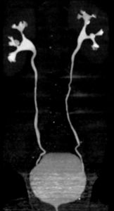 Figure 28.3 Uro-TDM : phase excrétoire, reconstruction dans le plan coronal pour obtenir un équivalent urographique.