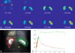 Figure 28.5 Images de scintigraphie dynamique au 99mTc-MAG3. A. Série de huit images d'une minute montrant l'évolution de la captation du traceur : vasculaire, puis parenchymateuse, puis urinaire. B. Dessin des régions d'intérêt autour des reins, du VG et d'un poumon, permettant la quantification. C. Courbes d'évolution de la quantité de traceur dans les reins : les deux reins ont la même fonction (50 %/50 %) ; le rein gauche a un drainage rapide, mais le rein droit a un drainage nettement ralenti en raison d'un syndrome de la jonction pyélo-urétérale.