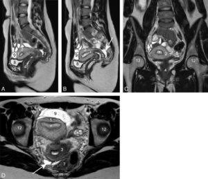 Figure 29.1 Coupes IRM en pondération T2 du pelvis d'une femme de 30 ans. 1. Fond de l'utérus ; 2. corps de l'utérus ; 3. col de l'utérus ; 4. vagin ; 5, 6. ovaires droit et gauche (plusieurs follicules sont visibles sous la forme de structures arrondies et hyperintenses) ; 7. rectum ; 8. vessie ; 9. anse grêle ; 10. corps du pubis ; 11. coccyx ; 12. têtes fémorales. Les étoiles sont dans la lumière utérine bordée par l'endomètre ; les flèches blanches montrent un seul récessus recto-utérin (cul-de-sac de Douglas), point déclive de la cavité péritonéale où s'accumulent les petits épanchements liquidiens. A. Coupe sagittale. B. Coupe parasagittale droite. C. Coupe frontale. D. Coupe horizontale. L'utérus est antéversé, un peu dévié à droite.