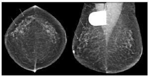 Figure 29.10 Foyer de microcalcifications (flèches) en mammographie correspondant à un carcinome canalaire in situ du sein droit.