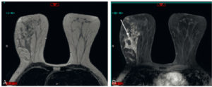 Figure 29.11 Carcinome canalaire in situ en IRM mammaire. Non-masse de distribution triangulaire orientée vers le mamelon (segmentaire) (flèche).