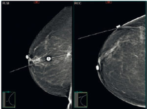 Figure 29.12 Repérage préopératoire d'un cancer du sein en mammographie. Grâce à un fil métallique, positionné par voie percutanée, le chirurgien peut retrouver l'anomalie à opérer.