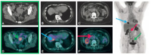 Figure 29.13 Examen TEP au 18F-FDG dans le bilan d'extension d'une tumeur du corps utérin grade 2, avec infiltration inférieure à 50 % du myomètre à l'IRM. L'examen montre la lésion du corps utérin (flèches vertes) (A, D) associée à une lésion du segment VIII du foie (flèches bleues) (B, E) et à une atteinte lymphatique précave (flèches roses) (C, F).