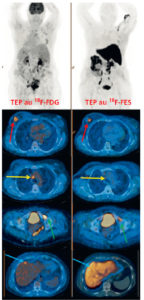 Figure 29.14 Examens TEP au 18F-FDG et au 18F-FES pour une même patiente présentant un cancer du sein métastatique. Les lésions cancéreuses, visibles sur la TEP au 18F-FDG (images de gauche), ont une expression hétérogène des récepteurs aux œstrogènes sur la TEP au 18F-FES (images de droite) : la lésion mammaire droite fixe intensément le 18F-FES (flèches rouges), les adénopathies médiastinales ne le fixent pas (flèches jaunes), la métastase osseuse de la branche ischiopubienne gauche le fixe faiblement (flèches vertes). Enfin, la métastase hépatique n'est pas évaluable du fait du métabolisme hépatique physiologique du 18F-FES (flèches bleues).