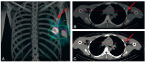 Figure 29.15 Lymphoscintigraphie aux nanocolloïdes d'albumine marquée au 99mTc d'un cancer du sein gauche. Repérage par tomoscintigraphique couplée à une TDM : visualisation des deux points d'injection (cercle vert) et d'un nœud lymphatique sentinelle axillaire (flèches).