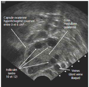 Figure 29.2 Ovaire normal d'une patiente en période d'activité génitale en échographie par voie endovaginale.