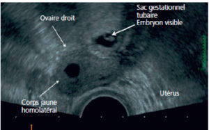 Figure 29.3 Grossesse extra-utérine en échographie par voie endovaginale.