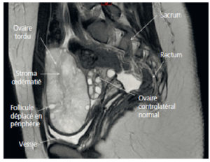 Figure 29.4 Torsion d'annexe (coupe sagittale en IRM en pondération T2).