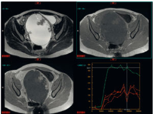 Figure 29.5 Masse ovarienne (coupes axiales en IRM en pondération T2/T1/T1 avec injection dynamique de gadolinium/courbe de perfusion IRM). Masse ovarienne uniloculaire avec végétations en signal T2 intermédiaire (flèche), se rehaussant après injection de gadolinium selon une courbe de type 2 (rehaussement modéré avec un plateau courbe rouge comparativement au myomètre [courbe verte]). Il s'agissait d'une tumeur borderline séreuse de l'ovaire.