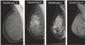Figure 29.6 Densité mammaire. Clichés mammographiques obliques montrant les différents types de densité mammaire.