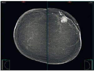 Figure 29.7 Mammographie bilatérale montrant une masse dense de forme ronde de contours spiculés correspondant à un carcinome canalaire invasif (flèche).