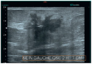 Figure 29.8 Échographie mammaire montrant une masse irrégulière de contours spiculés avec un halo hyperéchogène. Cette masse est classée ACR5.