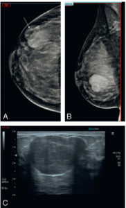 Figure 29.9 Diagnostic différentiel du cancer du sein : adénofibrome. En mammographie (A, B), il existe une masse peu dense de contours lisses de forme ovale (flèche) correspondant en échographie (C) à la présence d'un nodule hypoéchogène homogène de contours macrolobulés typique.