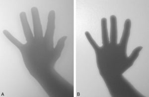 Figure 3.10 Influence de l'agrandissement et du flou dans l'image radiographique. Photographies sans modification d'échelle de l'ombre d'une main interposée entre le mur et une source de lumière. A. La main est positionnée proche de la source de lumière et loin du mur. B. La main est positionnée plus loin de la source de lumière et plus proche du mur. Noter que l'image A est plus grande, mais moins contrastée et plus floue que l'image B.