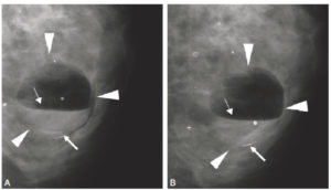 Figure 3.11 Mammographies (radiographies des seins) centrées sur la même région anatomique. A. La patiente a bougé pendant l'acquisition de l'image. B. L'examen a été répété et l'image est de bonne qualité. Il existe une image de niveau liquidien-huileux (têtes de flèche) et des calcifications parenchymateuses. Le niveau liquidien dans l'image est nettement plus flou en A qu'en B (flèche en pointillés), de même que certaines calcifications (flèches). L'architecture du parenchyme mammaire est aussi plus floue dans l'image A. L'image avec le niveau correspondait à une galactocèle (rétention lactée dans un conduit lactifère dilaté).