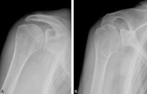 Figure 3.12 Bilan radiographique d'une épaule. A. Incidence de face en rotation interne de l'épaule droite, avec une inclination caudale (vers le bas) de 20° du rayon incident. B. Incidence de la même épaule réalisée avec une inclination caudale de 45° par rapport à l'horizontale du rayon incident (dite de Garth) ; cette incidence permet de dégager le bord antéro-inférieur de la glène. Noter la distorsion géométrique de la tête humérale sur l'incidence de Garth qui apparaît oblongue par rapport à l'incidence de face.