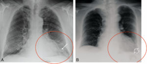 Figure 3.13 Signe de la silhouette. Les radiographies de face du thorax (A, B) montrent une zone de perte de la transparence du parenchyme pulmonaire dans la projection du lobe inférieur gauche (cercles rouges) compatible avec une pneumopathie. Noter que, dans l'image A, les contours cardiaques (VG) sont effacés à gauche, notamment au niveau de l'apex (flèche blanche), tandis que, dans l'image B, les contours cardiaques sont bien visibles malgré la présence de l'opacité pulmonaire (flèche vide). Il est donc possible d'affirmer que, dans l'image A, le foyer de pneumopathie est localisé dans la portion antérieure du lobe inférieur gauche ; le bord du cœur (de densité liquidienne) n'est plus visible. L'opacité siège donc dans le même plan que le cœur. Puisque celui-ci est en avant dans le thorax, l'opacité est antérieure. Dans l'image B, le foyer de pneumopathie est postérieur car le bord du cœur reste visible ; celui-ci n'est donc pas dans le même plan.