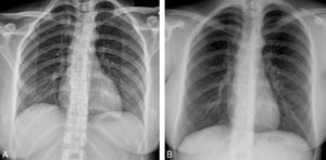 Figure 3.4 Deux radiographies de thorax de face prises avec des paramètres différents chez une patiente de 24 ans victime d'un traumatisme. A. Cliché réalisé pour la visualisation des structures osseuses (rachis, gril costal) avec les paramètres d'exposition suivants : 60 kV ; 400 mA ; temps d'exposition : 140 ms. B. Cliché de la même patiente réalisé pour l'évaluation du parenchyme pulmonaire avec les paramètres suivants : 120 kV ; 320 mA ; temps d'exposition : 20 ms. Noter une inspiration différente entre les deux clichés.