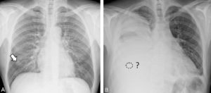 Figure 3.7 A. Radiographie du thorax de face. Un nodule pulmonaire de contours lobulés est visible dans le tiers inférieur du poumon droit (flèche). Ce nodule est visible car il est plus opaque que le parenchyme pulmonaire aéré qui l'entoure. B. Radiographie du thorax de face chez un patient présentant une réduction importante de la transparence du champ pulmonaire droit en rapport avec une pneumopathie et un volumineux épanchement pleural. Noter que, dans ce contexte, un nodule de caractéristiques similaires à celui de la figure A ne serait pas visible car sa densité est la même que celle de l'épanchement et du foyer de pneumopathie. Les deux opacités pleuro-pulmonaire et du nodule sont de densités hydriques identiques et se superposent : ces opacités sont indissociables (c'est le signe de la silhouette).