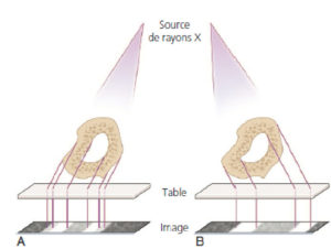 Figure 3.8 Schéma démontrant l'influence de la loi des tangentielles. Le même objet dans la même position est exposé à deux faisceaux de rayons X de directions différentes (A et B). Les lignes formées dans l'image de cet objet sont différentes. Dessin : Cyrille Martinet.