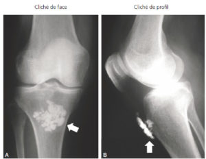 Figure 3.9 Radiographies du genou d'un patient se plaignant de douleurs antérieures du genou. A. Radiographie de face montrant une image opaque d'allure calcique projetée sur le tibia proximal (flèche). Il est impossible de savoir sur ce cliché à quelle profondeur se situe l'image calcique et de préciser si elle est intra-osseuse ou dans les parties molles : la possibilité d'une tumeur osseuse ne peut pas être exclue. B. Radiographie de profil du même patient montrant une projection superficielle de l'image calcique (flèche). Cette image est extra-osseuse et localisée en projection de la bourse infrapatellaire superficielle : il s'agissait d'une bursite chronique (inflammation chronique d'une bourse séreuse) chez un carreleur, liée à la position répétée à genoux.