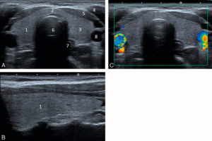 Figure 30.1 Échographie d'une thyroïde normale en coupes transversale (A) et longitudinale (B), et en coupe transversale en mode Doppler couleur (C). Le parenchyme thyroïdien est homogène, hyperéchogène par rapport aux muscles adjacents et les contours de la glande sont réguliers. Absence d'hypervascularisation en Doppler couleur. 1. lobe droit ; 2. isthme ; 3. lobe gauche ; 4. muscle sternocléidomastoïdien gauche ; 5. muscles sternothyroïdien et sternohyoïdien gauches ; 6. trachée ; 7. œsophage ; 8. artère carotide commune gauche.