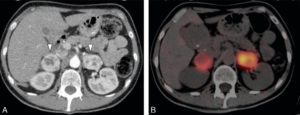 Figure 30.10 Imagerie du phéochromocytome. A. TDM abdominale au temps artériel montrant deux masses surrénaliennes hypervasculaires avec une composante kystique. B. Image scintigraphique à la MIBG fusionnée à la TDM montrant une hyperfixation intense des syndromes de masses surrénaliens, compatibles avec un phéochromocytome bilatéral.