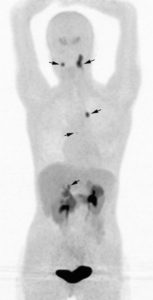 Figure 30.11 TEP à la 18F-DOPA dans un phéochromocytome/paragangliome héréditaire. Multiples lésions tumorales développées aux dépens des paraganglions vagaux cervico-médiastinaux (paragangliomes) et de la médullosurrénale droite (phéochromocytome).