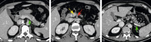 Figure 30.12 Aspect normal du pancréas en TDM : coupes TDM injectées axiales chez un patient de 25 ans (A, B) et chez un autre patient de 57 ans (C). 1. Queue du pancréas ; 2. corps du pancréas, séparé de la queue par le croisement de l'artère splénique ; 3. isthme du pancréas (en avant des vaisseaux mésentériques supérieurs) ; 4. tête du pancréas ; 5. foie ; 6. rate ; 7. veine cave inférieure. Flèche blanche : veine porte ; flèche jaune : veine mésentérique supérieure ; flèche rouge : artère mésentérique supérieure ; flèche verte : veine splénique. C. Aspect d'atrophie physiologique avec l'âge : les contours du pancréas deviennent plus irréguliers (têtes de flèche).