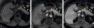 Figure 30.13 Aspect normal du pancréas en IRM : coupes IRM axiales en séquence T1 avec saturation de la graisse (Fat Sat), sans injection de produit de contraste (A) et après injection de produit de contraste au temps artériel (B) et au temps portal (C) chez un patient de 50 ans. Le corps et la queue du pancréas sont bien visible sur ces coupes (têtes de flèche blanches). Le pancréas est en signal intermédiaire spontané sur la séquence T1 sans injection de produit de contraste (A), de rehaussement homogène, sans lésion focale sur les séquences réalisées aux temps artériel et portal (B, C). Le conduit pancréatique (de Wirsung) est très fin, à peine visible (tête de flèche orange). 1. Foie ; 2. estomac ; 3. surrénale droite ; 4. surrénale gauche ; 5. aorte abdominale ; 6. artère hépatique ; 7. veine cave inférieure ; 8. veine porte.