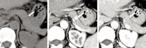 Figure 30.14 Tumeur neuro-endocrine du pancréas (insulinome) chez une patiente de 35 ans. TDM abdominale en coupe axiale sans injection de produit de contraste (A), puis au temps artériel (B) et au temps portal (C) après injection. Visualisation d'un nodule pancréatique situé sur le corps, mesuré à 1 cm, visible uniquement au temps artériel. Cette image est très évocatrice de tumeur neuroendocrine pancréatique, ce d'autant qu'il n'existe pas de retentissement canalaire, c'est-à-dire que le conduit pancréatique n'est pas dilaté par la présence de la tumeur et reste très fin, non visible comme habituellement en TDM.