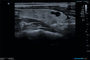 Figure 30.2 Coupe longitudinale du lobe droit thyroïdien. Visualisation d'une formation kystique liquidienne anéchogène pure de 9 mm de grand axe. Il s'agit d'un kyste thyroïdien, classé EU-TIRADS® 2.